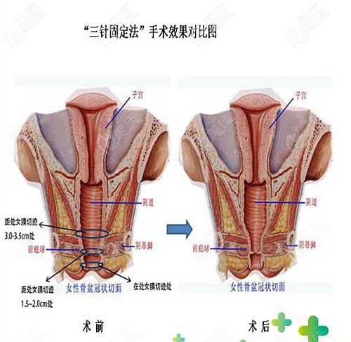 容脈新做埋線縮陰的優(yōu)勢 容脈新做埋線縮陰的優(yōu)勢