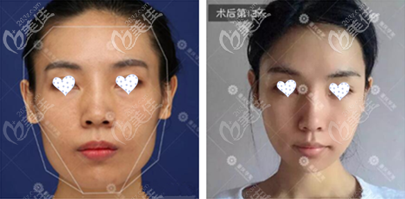 重慶華美潘寶華下頜角+顴骨磨骨效 果圖