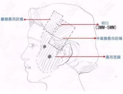 微創(chuàng)懸吊術(shù)的切口位置