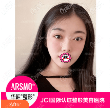 做歐洲之星面部提拉間隔一個月又做了一次,做完兩次后效果更是好點