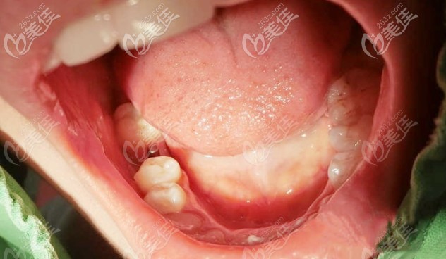 牙齒剛剛裝上基臺時