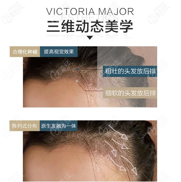 維多利亞美學(xué)植發(fā)技術(shù)