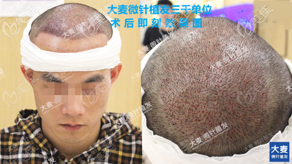 大麥微針植發(fā)3000單位效果圖