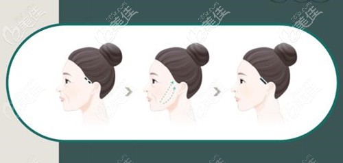 Elasticum彈力提升原理