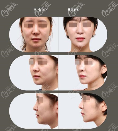 韓國原辰Elasticum彈力提升案例