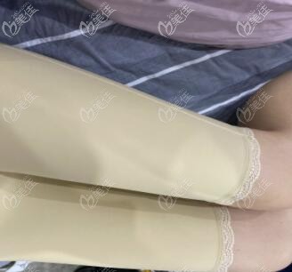 吸脂術(shù)后8天恢復(fù)照