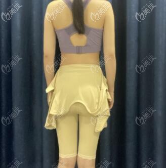 腰腹大腿吸脂術(shù)后半個(gè)月照