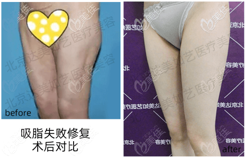 顧客在達美如藝做大腿吸脂失敗修復(fù)改善了凹凸不平的情況 顧客在達美如藝做大腿吸脂失敗修復(fù)改善了凹凸不平的情況