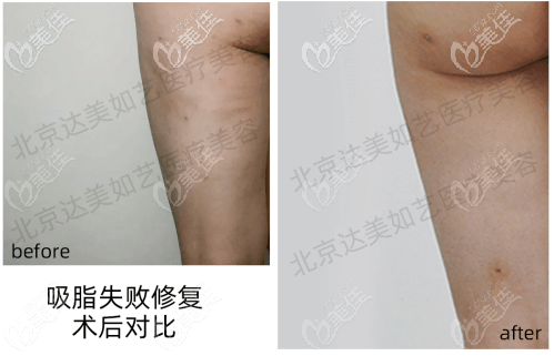 北京達美如藝大腿吸脂失敗修復(fù)案例 北京達美如藝大腿吸脂失敗修復(fù)案例