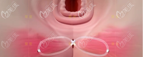 生物束帶私密緊縮術(shù)只會(huì)陰淺橫肌修補(bǔ)術(shù)