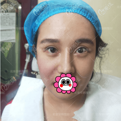 做熱拉提感覺不疼就是臉熱乎乎的