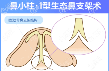 重慶時(shí)光I型肋骨鼻支架術(shù)