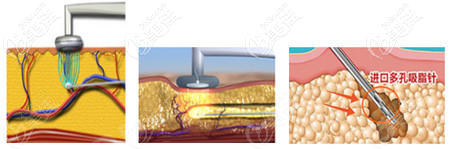 黃金微雕溶脂射頻溶脂過程示意圖 黃金微雕溶脂射頻溶脂過程示意圖