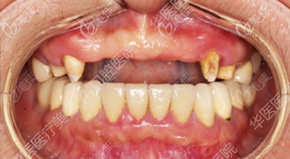 種植前的口內(nèi)照 種植前的口內(nèi)照