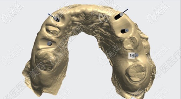 3D數(shù)字化導(dǎo)板電腦設(shè)計(jì)圖 3D數(shù)字化導(dǎo)板電腦設(shè)計(jì)圖