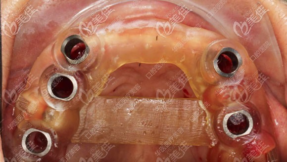 種植牙導(dǎo)板示意圖 種植牙導(dǎo)板示意圖