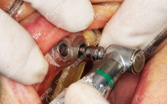 使用導(dǎo)板的種植過程 使用導(dǎo)板的種植過程