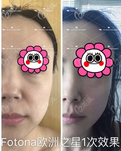 武漢藝星去眼袋和法令紋一個月效果