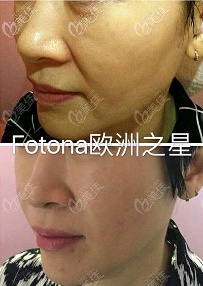 武漢藝星歐洲之星中線面部除皺一個月效果