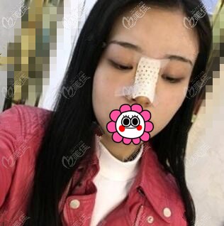 隆鼻術(shù)后2天照