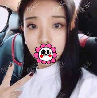 隆鼻術(shù)后9天照