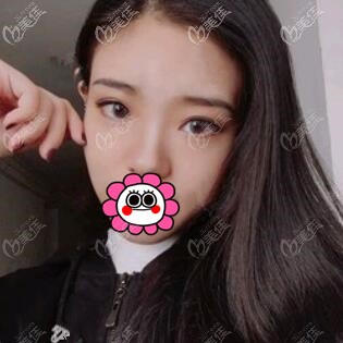 耳軟骨復(fù)合隆鼻術(shù)后20天照