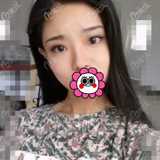 三亞維多利亞醫(yī)療美容做耳軟骨復(fù)合隆鼻真人效果反饋：鼻梁終于變的立挺有型了！