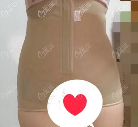 去邵陽(yáng)曹家整形做腰腹吸脂3000cc恢復(fù)15天效果圖