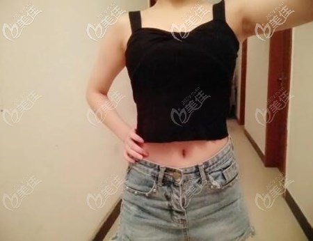 去邵陽曹家整形做腰腹抽脂抽了3000cc,恢復(fù)3個(gè)月后體重沒輕但腰圍瘦了6cm