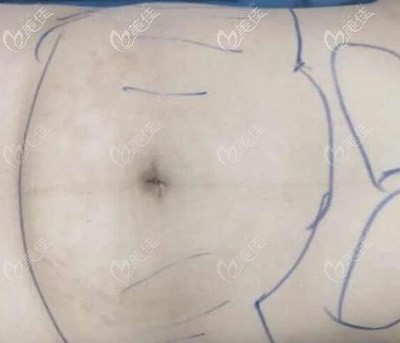 在郴州曹家整形做腰腹抽脂術(shù)前照片 在郴州曹家整形做腰腹抽脂術(shù)前照片