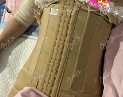 腰腹吸脂1-7天 恢復(fù)效果圖片 腰腹吸脂1-7天 恢復(fù)效果圖片