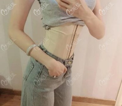 腰腹抽脂3000cc恢復(fù)25天效果圖 腰腹抽脂3000cc恢復(fù)25天效果圖
