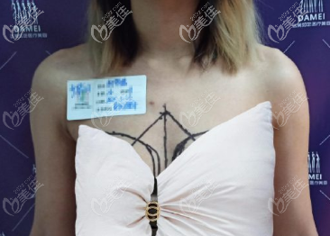 在北京達(dá)美如藝做假體隆胸前 在北京達(dá)美如藝做假體隆胸前