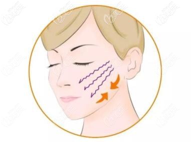 5d面部提升術(shù)的優(yōu)勢