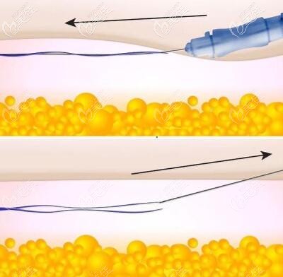 5d面部提升技術(shù)原理過程