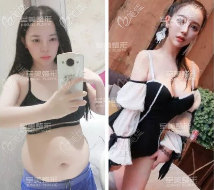 重慶軍美章小平腰腹部吸脂瘦肚子效果圖