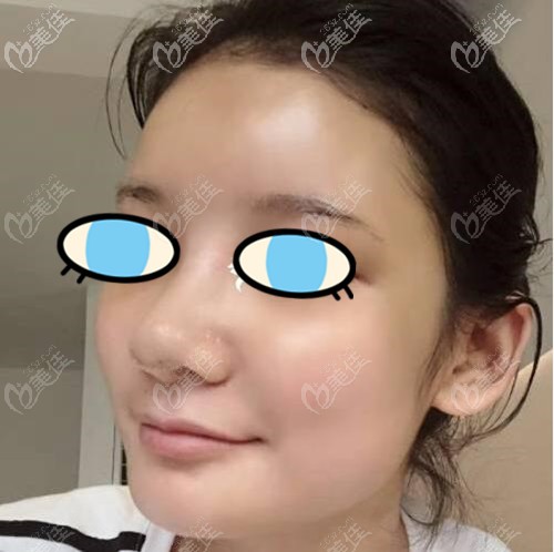 膨體隆鼻術(shù)后十天效果 膨體隆鼻術(shù)后十天效果