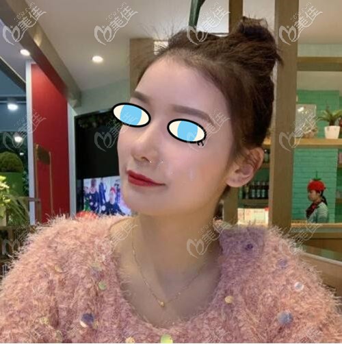 南寧夢(mèng)想膨體隆鼻后期效果:術(shù)前的鼻梁塌陷不見了,只留下挺翹立體