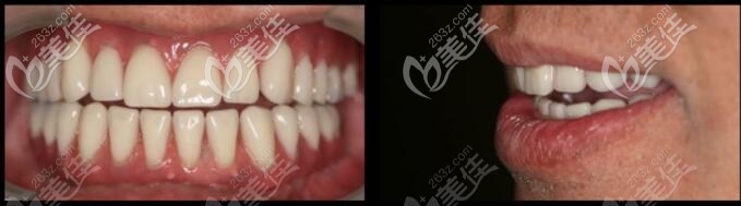 下頜半口馬龍橋修復效果圖 下頜半口馬龍橋修復效果圖