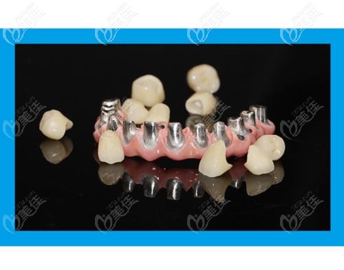 什么是種植馬龍橋 什么是種植馬龍橋