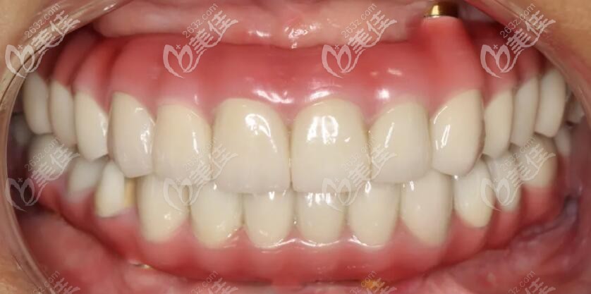 看昆山美奧口腔做的半口種植牙馬龍橋修復(fù)案例，分析馬龍橋的優(yōu)缺點