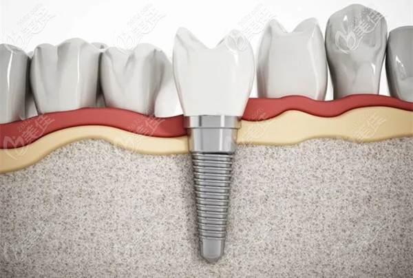 聽說在呼市華醫(yī)口腔醫(yī)院做一顆種植牙才4999元,還附送德國威蘭德全瓷牙冠呢