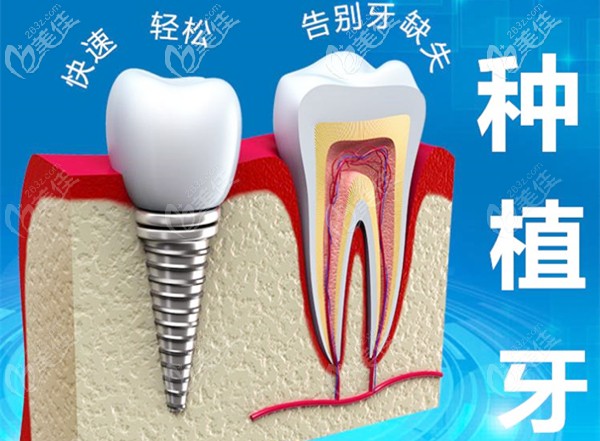 種植體和牙冠的模型圖