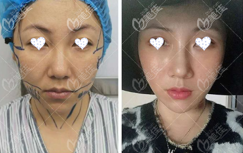 韓國醫(yī)生李成俊面部mini拉皮除皺手術恢復照片，花費8萬