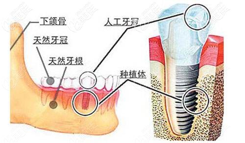 種植體在牙槽骨的位置示意圖