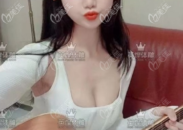 禁不住夸贊項(xiàng)力源自體脂肪豐胸技術(shù),說項(xiàng)力源豐胸成活率較高自然有道理