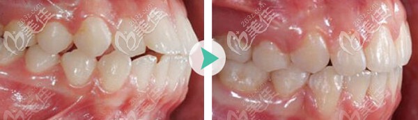 矯正案例--齙牙
