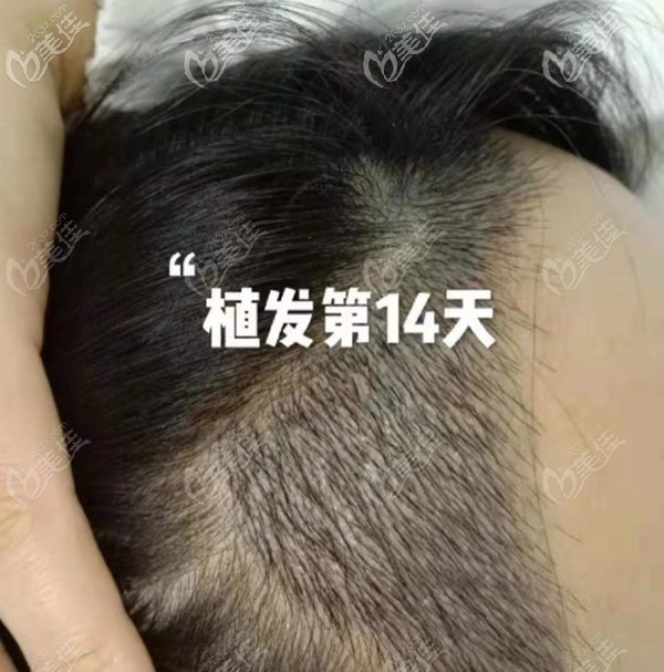 女士種植發(fā)際線14天效果圖
