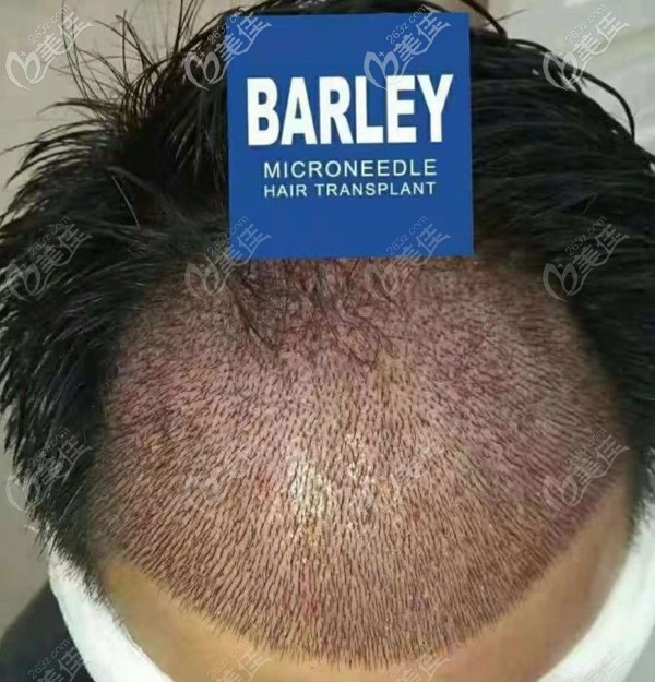 男士前額微針植發(fā)即刻效果圖