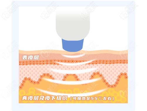 熱瑪吉治療面部下垂的原理